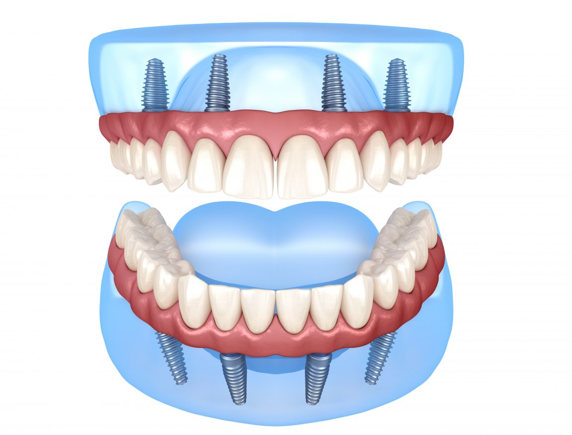 all on 4 implant example