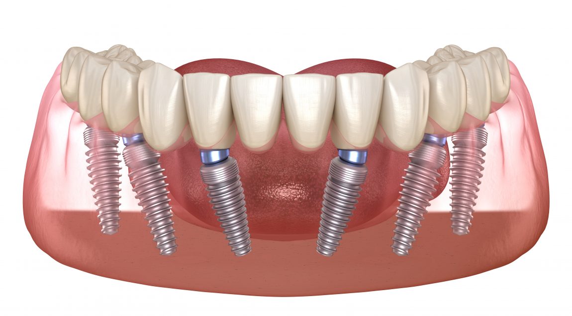all on 6 dental implants example