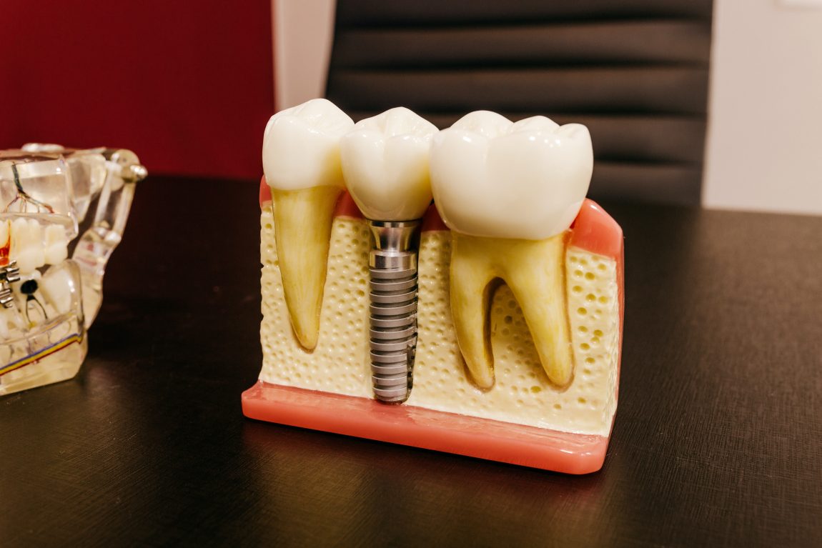 dental implant example