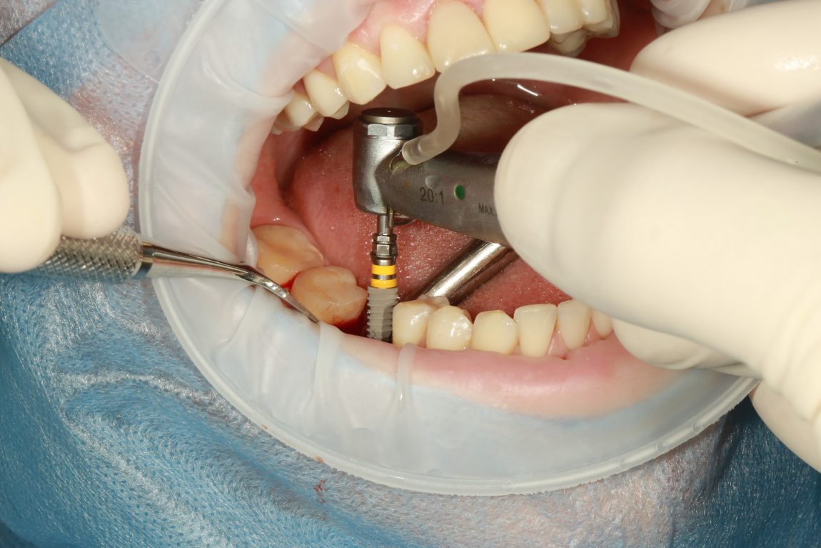Standart dental implant